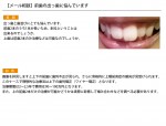（写真）前歯の出っ歯に悩んでいます