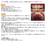 前歯の出っ歯に悩んでおります。上の前歯だけ矯正することは可能でしょうか。