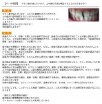 すきっ歯で悩んで　上も下も隙間がすごい　上の歯だけ部分矯正は？　舌側矯正で期間は
