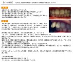 私の出っ歯は部分矯正で上の歯だけの矯正が可能？矯正期間や金額が