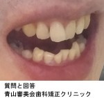 質問）前歯の歯並びが気になり、部分矯正は可能でしょうか