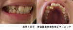 質問)　矯正に関して相談　上の歯だけ歯並びが悪く、部分的に矯正