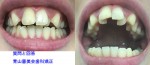 上の前歯のみ舌側希望、部分矯正は可能なのでしょうか