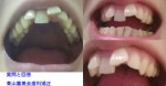 前歯の歯並びで悩んでいます。部分矯正は可能ですか。費用を