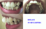 出っ歯で悩んでいます。特に前歯二本だけが大きく出ているため口が閉じにくいです。