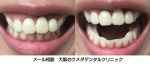 歯が出ているので悩んでいます。 前歯3本は、裏側が金属の差し歯です。