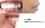 横から見ると歯と唇が出ているのがコンプレックスです。