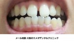 年々前歯のすきっ歯が広がっており、現在では2～3㎜の開きがあります。
