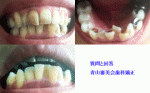 下の歯の部分矯正を舌側矯正で考えています。