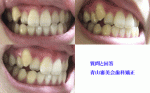 上顎の右側の八重歯ですが、部分矯正できるでしょうか。