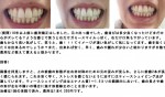 10年以上前に歯列矯正はしました。元々出っ歯でした。歯並びは多少良く