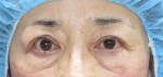 他院眼瞼下垂手術後のびっくり目を治す！