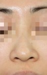 色々やって、少しの変化？鼻の美容外科手術。