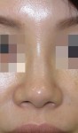 鼻尖軟骨縫縮（団子鼻手術）の変化と効果