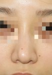 複合手術（鼻尖軟骨縫縮+鼻シリコン（プロテーゼ）入れ替え術）で、鼻の雰囲気を変える！