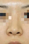 何が変わった？ 鼻尖軟骨縫縮（団子鼻手術）の効果と経過。