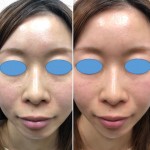 目の下のクマ&鼻＆アゴ✨ヒアルロン酸 オールカスタマイズ治療