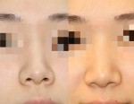 鼻の穴の見え方が変わる？！鼻尖軟骨縫縮（団子鼻手術）の効果と腫れ方