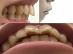 矯正をしたいと考えています。 私の場合、前歯二本の歯が大きく歯が外側に向いていることと、歯茎自体が