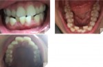 歯並びが悪く、歯列矯正を考えて　治療内容と治療費用を教えて下さい　期間は長くてどの程度かかりますか