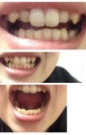 審美歯科の費用や治療期間の質問です 八重歯だけを整える？前歯(6本)を全部？