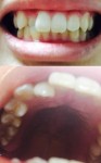 歯並び、矯正の相談   右前歯が1本奥に引っ込んで  歯磨きを入念に  期間・費用は