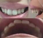 前歯2本だけの舌側部分矯正を　前歯2本が前に出て　口がこんもり見えてしまい、引っ込めたい