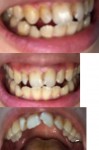 前歯と開口が気になります。 左前歯が昔より前に出てきて目立つようになってしまいました