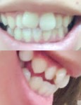 上前歯の矯正を考えています　斜めになっているのと前歯だけ2本前に出てるのが気に　どの様な矯正が