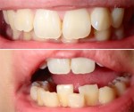 下の前歯の歯並びが気になります。 希望は下の前歯の歯並びだけを直したい、部分矯正できますか？