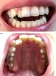 前歯の横の歯が内側に生えていて、 揃っていないことに悩んでいます。 治療方法と費用、期間を教えて