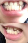 この反対咬合の歯並びは部分矯正で治せますか？