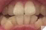 この出っ歯は上顎突出に該当するの？下の歯列矯正もするとしたら幾らぐらい掛かるのか教えて