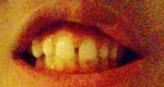 出っ歯とすきっ歯で悩んで　目立たない矯正が希望　裏側のワイヤーの矯正など　矯正期間が短いのが