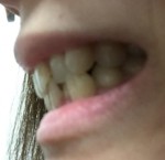 上下の前歯の歯並びがガタガタで　上の前歯 真ん中2本が出て八重歯が出て　前歯だけの部分矯正がしたい