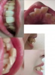 部分矯正について 前歯2本がでているのと、大きいのがきになり　この前歯は部分矯正できるは？