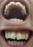 前歯2本が ねじれていてコンプレックス　治したいのはこの2本だけ　裏側の部分矯正が可能？