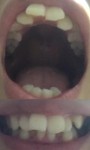 上前歯の歯並びが悪く、出っ歯なのが気になり　前歯だけの部分矯正で治せます？滑舌が不明瞭なことも悩んで