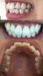 前歯二本がとびでてる　前歯がでかすぎる　以前矯正して　裏側矯正を希望　費用や治療方法を