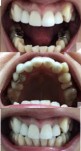 幼い頃から歯並びに悩んで　前歯5本神経治療をしセラミック　部分矯正治療は可能？　妊婦でも矯正は可能？