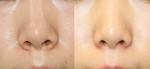 小鼻縮小すると、小鼻の位置が変わる？