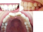 出っ歯で 寝ている時 歯ぎしり 歯がすり減り 口を開けっぱなし 口を閉めるとあごがでこぼこ アデノイド