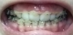 現在抜歯矯正治療を受けていますが、悩みであるガミースマイル、口元の突出は改善されないと