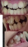 永久歯に生え変わる時から歯並びが悪かった　顎が大きくなると助言を　期間的にも経済的にも部分矯正が