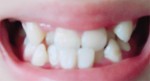 受け口で悩んで　歯並びが悪いことが原因で受け口に　学生のため安い治療費で受け口を治したい