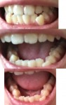 下の歯の歯並び悪く　前歯の噛み合わせが悪く　奥歯が噛み合わず　どんな矯正で治す？　どれくらい改善が？