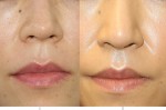 人中短縮術（にんちゅうたんしゅくじゅつ、リップリフト、上口唇短縮術）の変化と効果