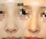 高すぎちゃった！！他院（韓国）鼻手術の修正。
