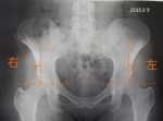 先天性臼蓋形成不全で、50歳で人工関節と診断されてから7年  公認講師のリブログです。