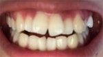 前歯の開口が　歯並びと噛み合わせを治したい　裏側矯正をしたい　値段、期間など